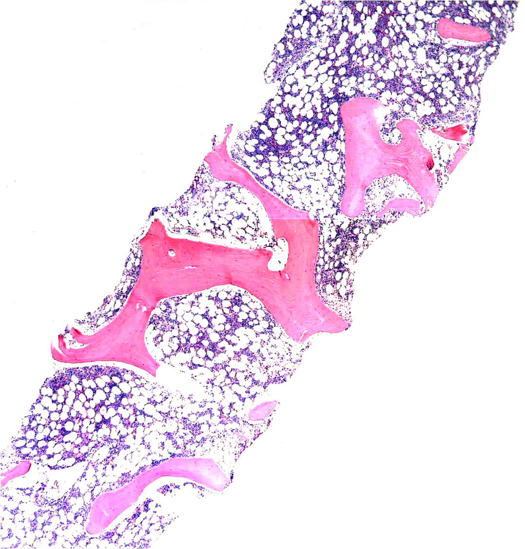 Core biopsy demonstrates mild hypercellularity for age (approximately 50%).